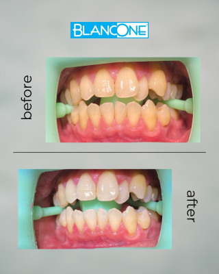 BlancOne® Teeth Whitening – Next-Generation Whitening Technology