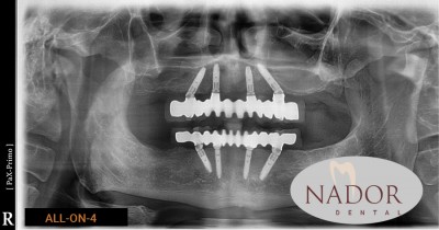 Mitől sikeres egy fogászati implantáció?